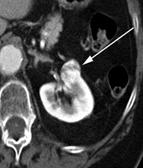 xray of a tumor